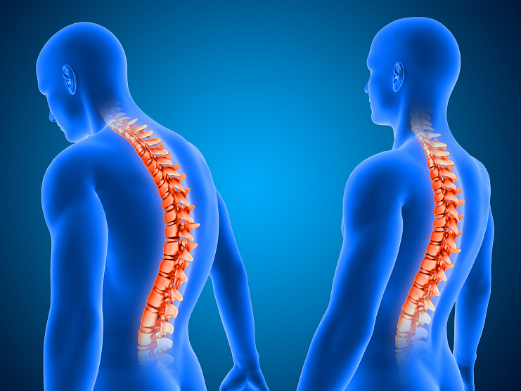 腰痛-椎間盤突出-運動