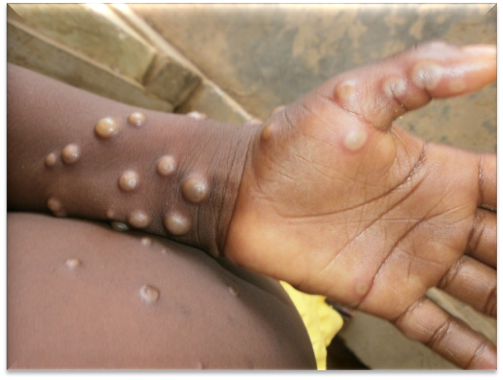 猴痘-猴痘症狀- 預防猴痘