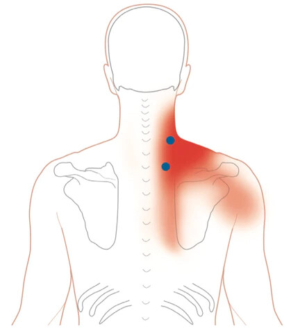 運動科學-痛症-物理治療-頸痛-提肩胛肌